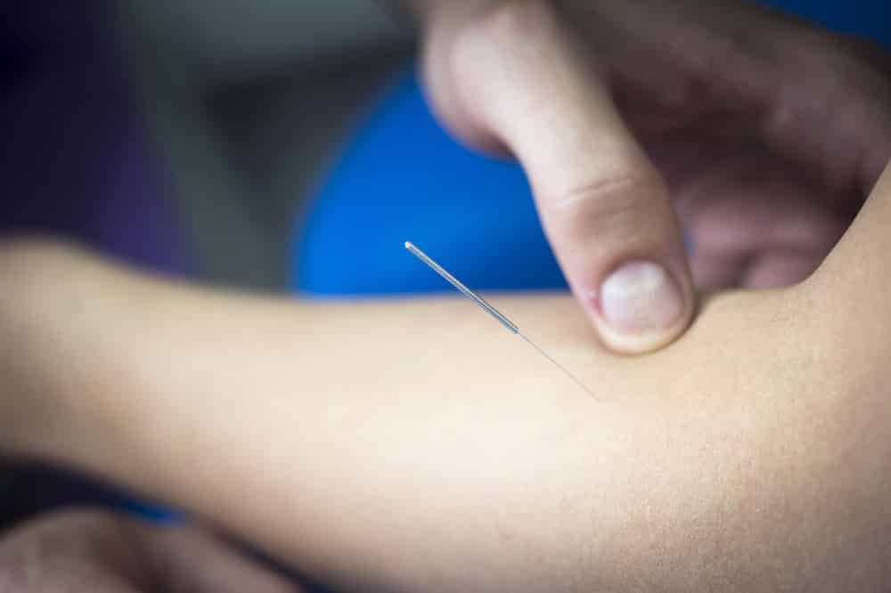 dry needling